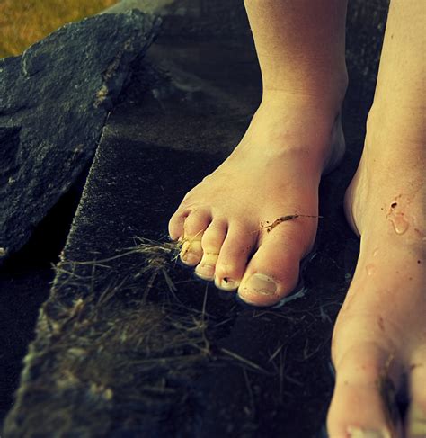 ugly toe pics|334 Images Of Ugly Feet Stock Photos & High.